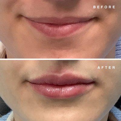 Lip Filler before & after