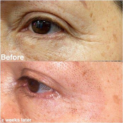 Fibroblast Treatment - skin tightening and lift. Cost: crows feet $300 a session