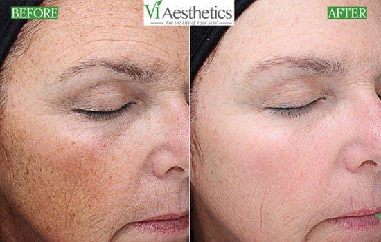 Make Wrinkles Disappear