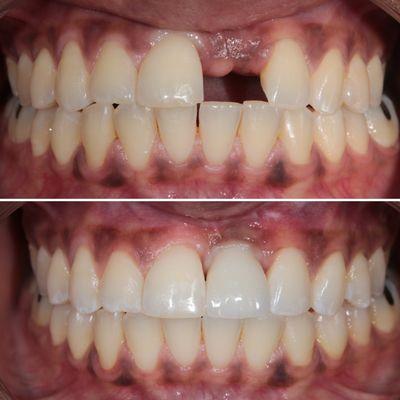 Single Missing Tooth Replaced with Dental Implant