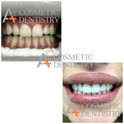 ZOOM Whitening Before and After.