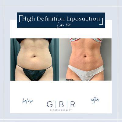 Liposuction in Virginia beach