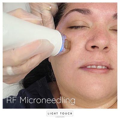 Secret Rf Microneedling  - Light Touch Laser Spa NYC