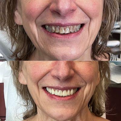 Life changing results with this full mouth smile makeover!