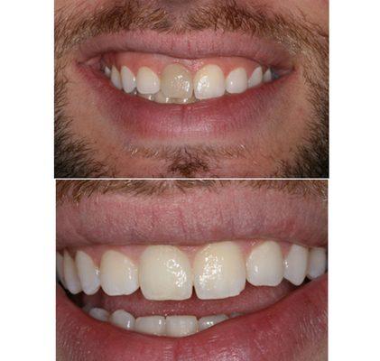 Before & After Discolored Tooth