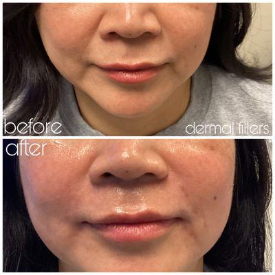 dermal filler marionette lines