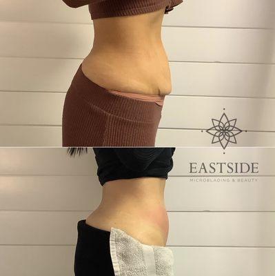 Amazing mommy makeover abdomen fat sculpting and skin tightening. The safest non-invasive treatment!