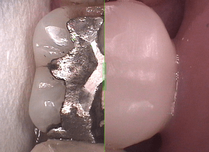 Before and After: Broken Tooth