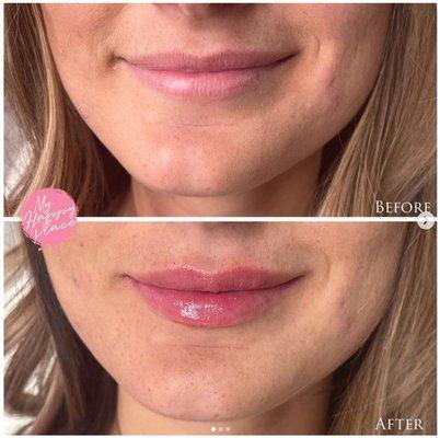 LIPS. 1/2 syringe for just a subtle plump