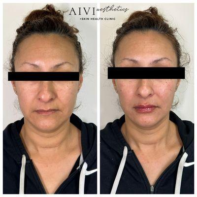 Facial Balancing with fillers.