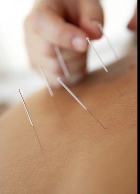 Acupuncture needles