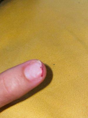 Yanked nail!