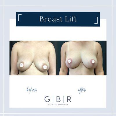 Mastopexy "breast lift"