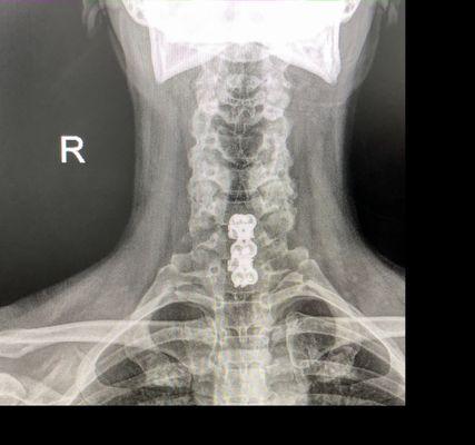 Cervical Spine Surgery - front view  08/09/2021