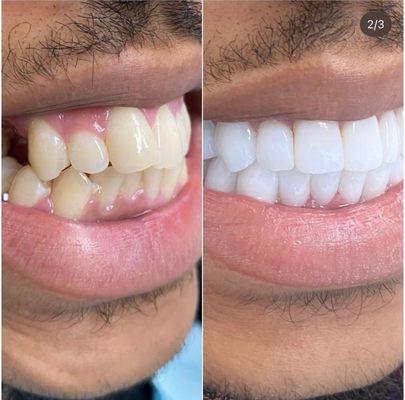 Before and after of our veneers.