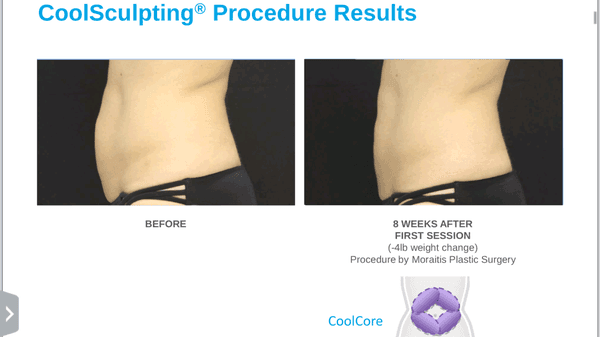 Coolsculpting of the abdomen by Moraitis Plastic Surgery