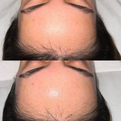 Hydro Facial Before & After