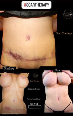 SCAR THERAPY POST SURGERY