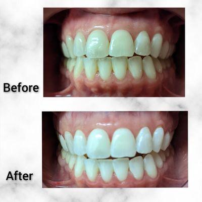 Cosmetic Teeth Whitening