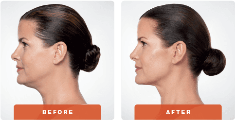 Kybella Before and After