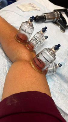 Cupping for Tennis Elbow/ Elbow pain