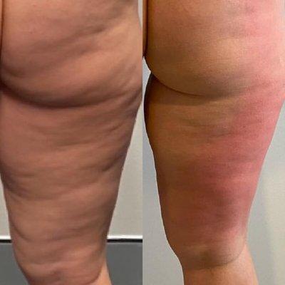 12 cellulite treatment sessions. Text 206-331-8106 for free consultation.