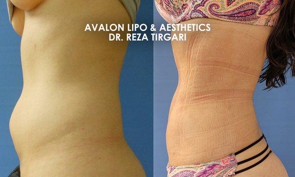 Before & After Liposuction with Dr. Tirgari - www.lipoandaesthetics.com - Abdomen