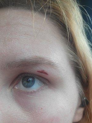 Right eye after two days.