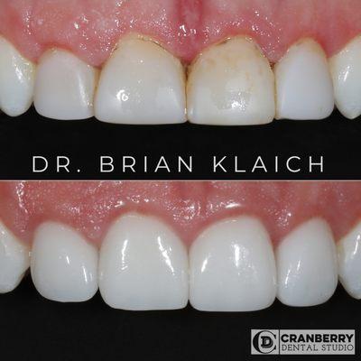 With gum recontouring and 4 porcelain veneers, Dr. Brian was able to restore this patient's gum health and give her a beautiful smile!