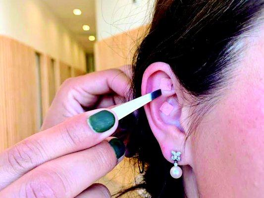 Ear Seeding