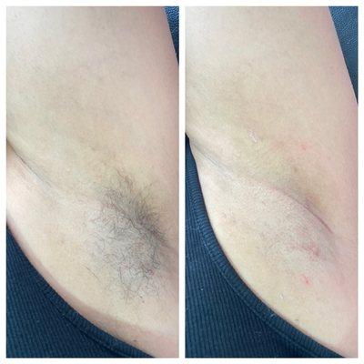 Before and after underarm wax