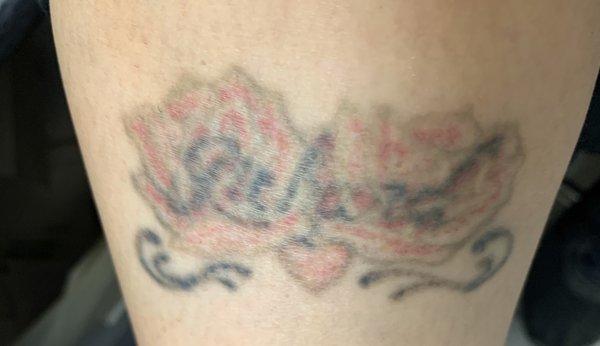 Removery Tattoo Removal & Fading