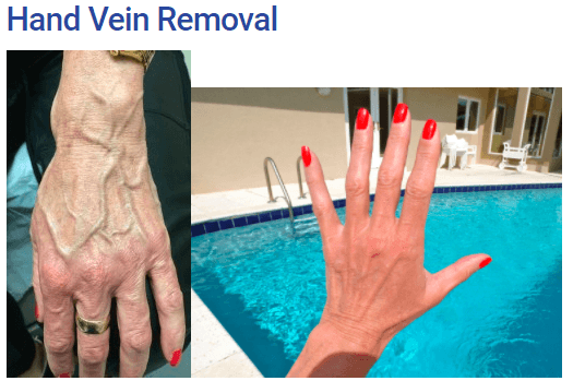 Beautiful Hands after Vein911 Treatment!!