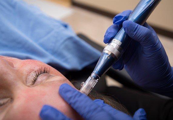 Mirror Mirror Beauty Boutique performs its medical microneedling treatments using the SkinPen, from trusted Bellus Medical.