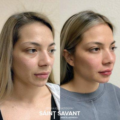 FULL FACE Nonsurgical REJUVENATION using dermal fillers