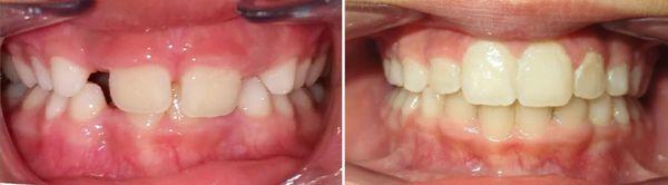 My son's before and after pics. Dr. Ashouri did great work, and now my daughter is a patient too.