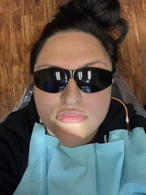 Me getting fillings and numbed up real well.