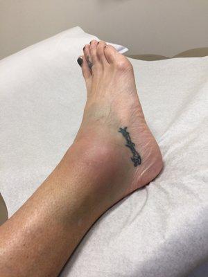 My unhappy Right Ankle sprain. Doc C said: "No high heels"