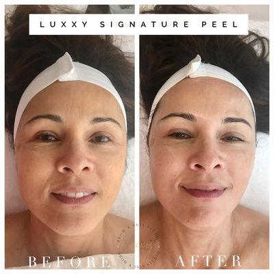 Client before and after Luxxy Signature Peel. Diminished fine lines, skin is firmer and lifted, suppleness increased, and radiance defined.