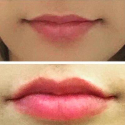 Before and after Dr. Bitter's perfectly sexy lip augmentation