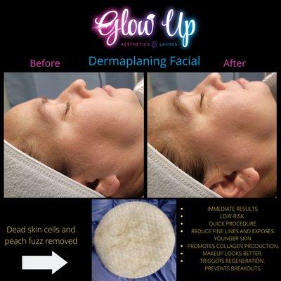 Dermaplane Facial