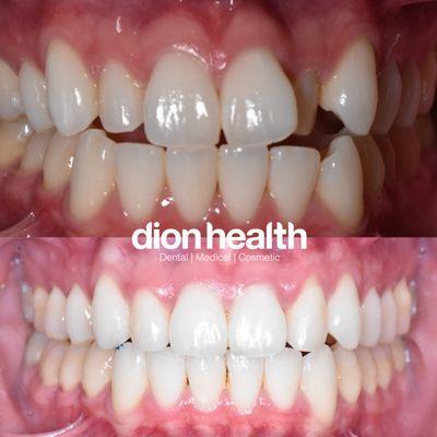 clear ortho aligners