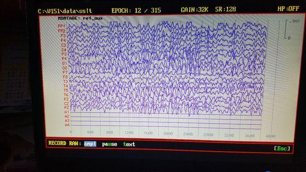 Electroencephalogram (EEG) evaluation of the electrical brain activity before Neurofeedback starts!