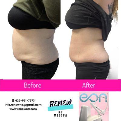 EON robotic body contouring and Semaglutide combo treatment.