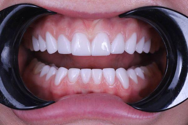 Full Mouth Porcelain Veneers / Full Mouth Rehabilitation