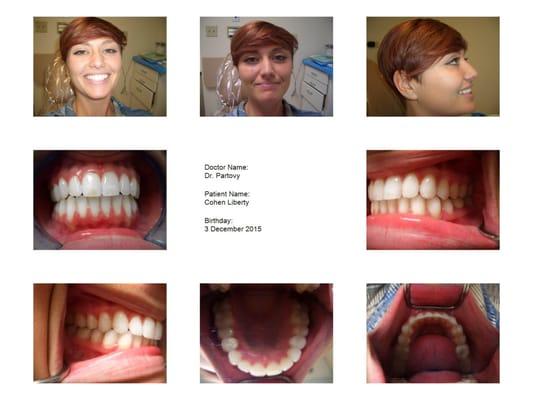 Before my invisilign treatments my teeth were over crowded. Now I love smiling in pictures. Thanks Doctor Partovy!