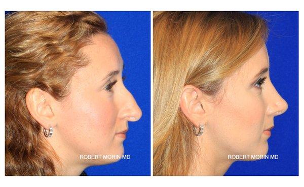 A 24 year old female patient unsatisfied with the proportion and shape of her nose visited Dr. Morin for a septorhinoplasty.