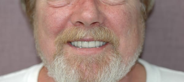 These are his own teeth restored with crowns. Have been in function for approximately 10 yrs. ( Dr. Sullivan )