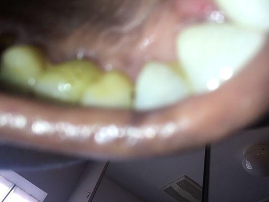 See the little hole like and look and the teeth they put there yellow not white but yellow. I'm am a unsatisfied customer patient