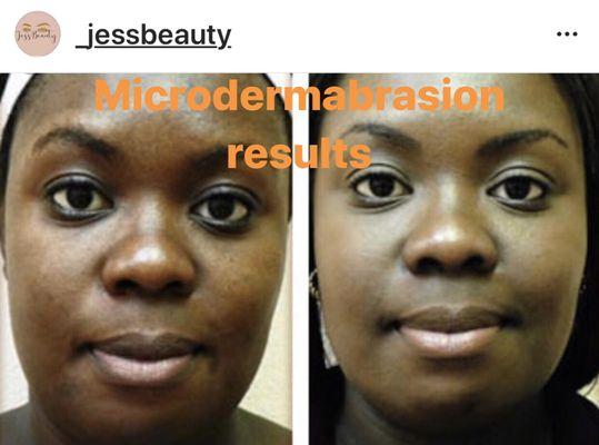 Results from 3 sessions of microdermabrasion and enzyme peels